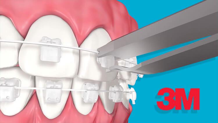 Tổng quan về niềng răng bằng vật liệu 3M