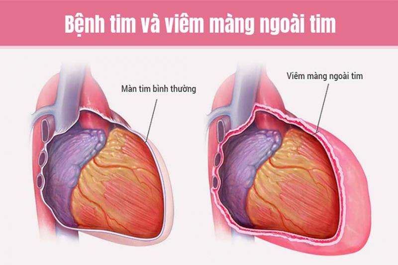 19-21 giờ: Thời gian giải độc màng ngoài tim
