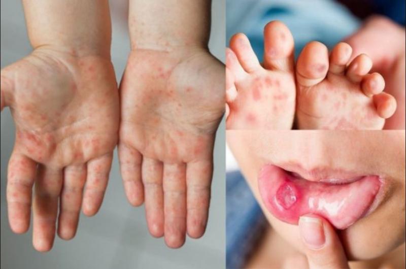 Bệnh chân tay miệng ở trẻ em