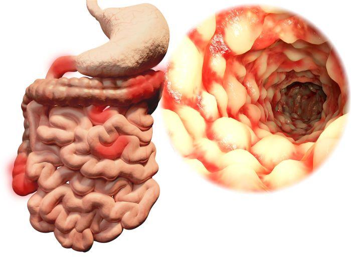 Bệnh Crohn là gì?