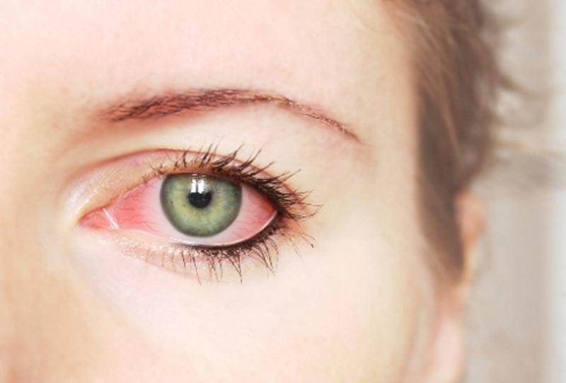 Bệnh đau mắt đỏ