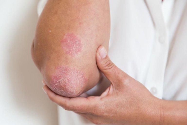 Bệnh eczema có lây không?