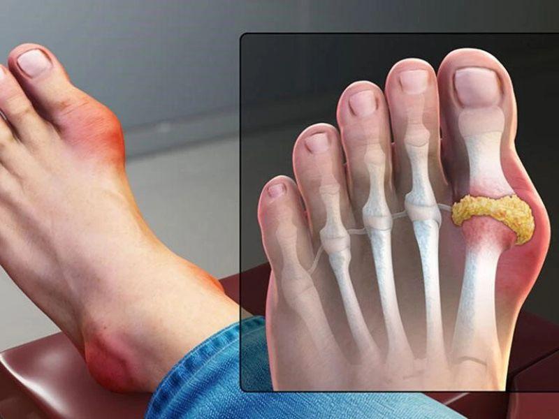 Sưng phù ở tay, chân là biểu hiện của bệnh gout