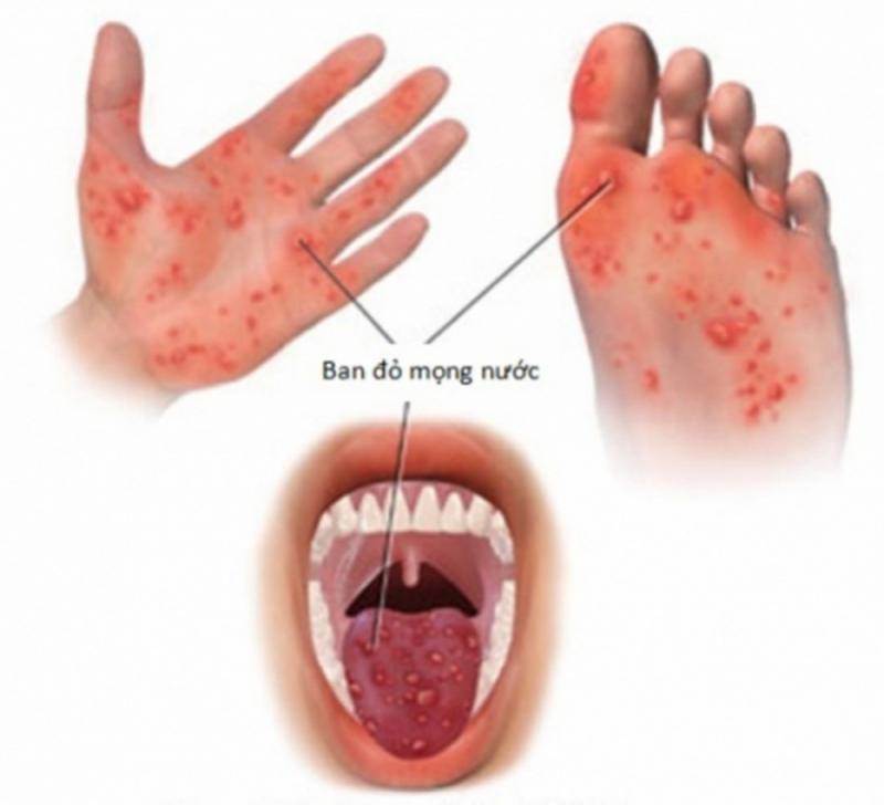 Triệu chứng của bệnh tay chân miệng