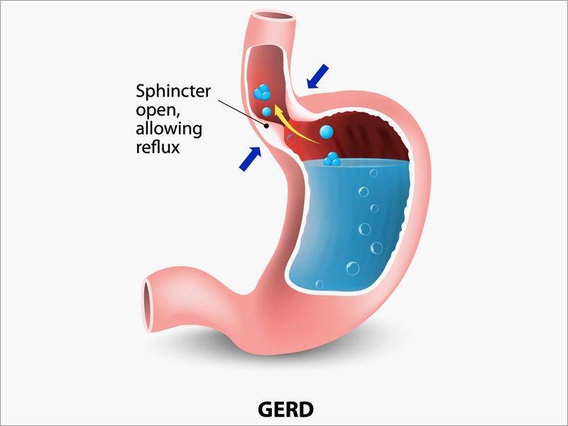 Bệnh trào ngược dạ dày - thực quản (Gerd)