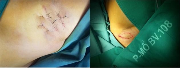 Phẫu thuật mổ mở đường mổ nhỏ và phẫu thuật cắt vạt da