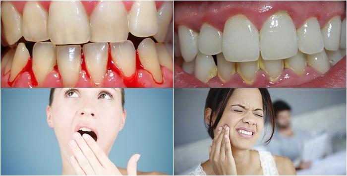 Viêm nha chu là nguyên nhân gây mất răng