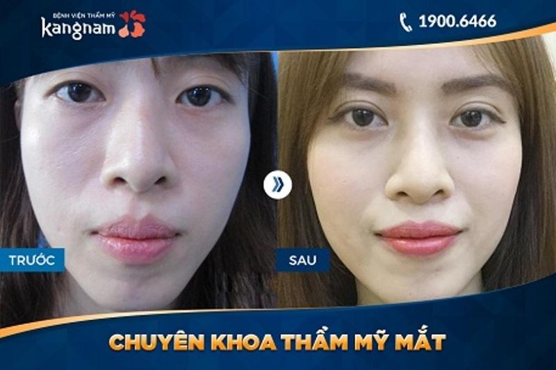 Hình ảnh khách hàng cắt mắt hai mí tại TMV Kangnam