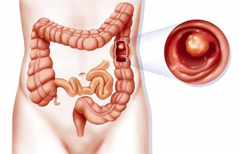 Ung thư ruột kết - Biến chứng bệnh Crohn