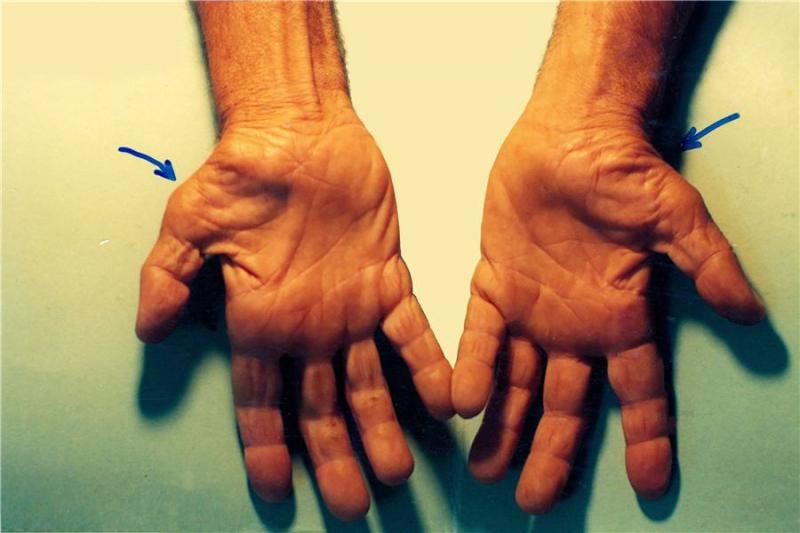 Hội chứng ống cổ tay - Một trong những biến chứng của viêm khớp dạng thấp