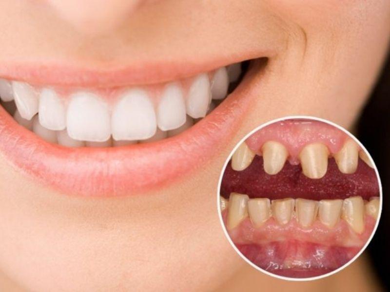 Sau khi bọc răng sứ, răng sẽ không thể trở lại như ban đầu