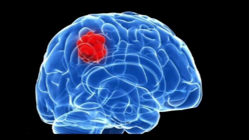 Giống như với nhiều loại bệnh ung thư khác, u não cũng được chia thành nhiều giai đoạn khác nhau, với mức độ phát triển của bệnh là khác nhau.