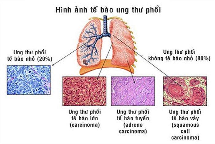 Giai đoạn ung thư phổi không tế bào nhỏ