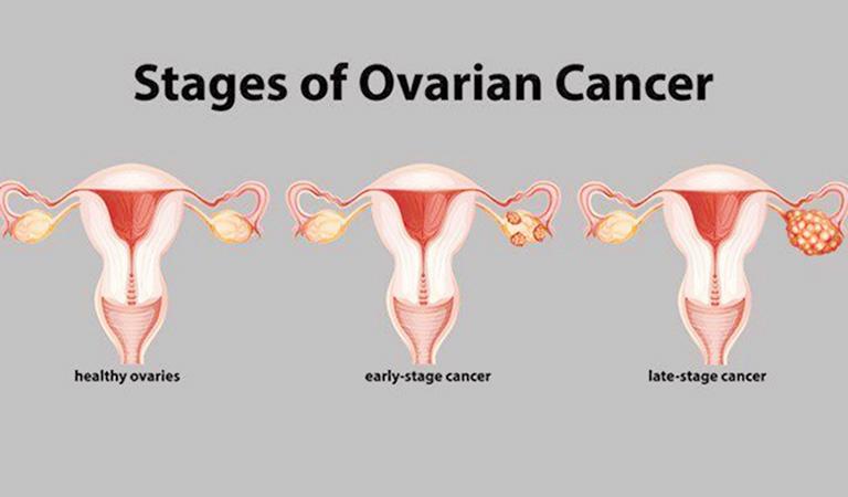 Các giai đoạn phát triển ung thư buồng trứng