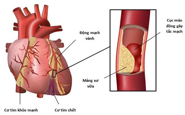 Xơ vữa động mạch vành