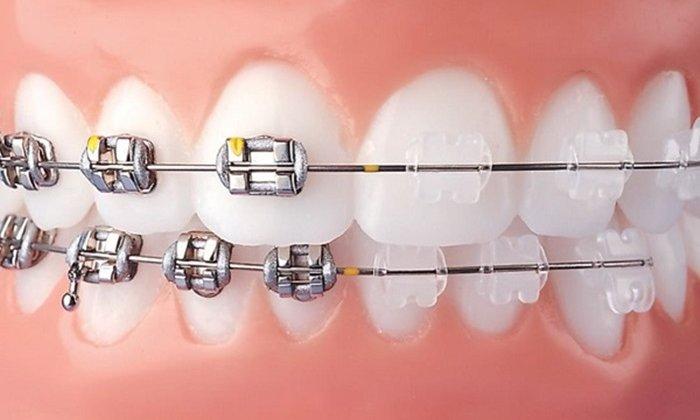 Ưu điểm và hạn chế của niềng răng mắc cài kim loại