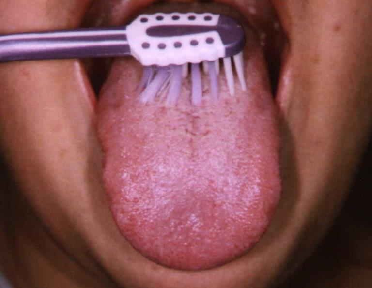 Việc vệ sinh răng miệng kém dẫn đến việc xuất hiện các mảng trắng, bựa trên lưỡi