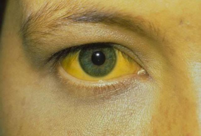Vàng da, vàng mắt