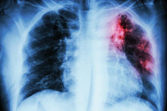 Chẩn đoán bệnh lao phổi
