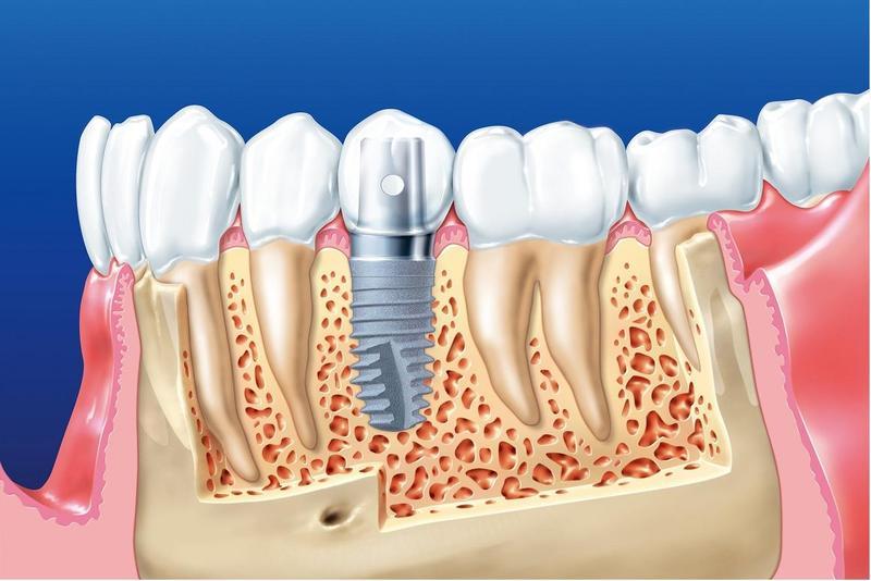 Cần chuẩn bị gì trước khi trồng răng implant?