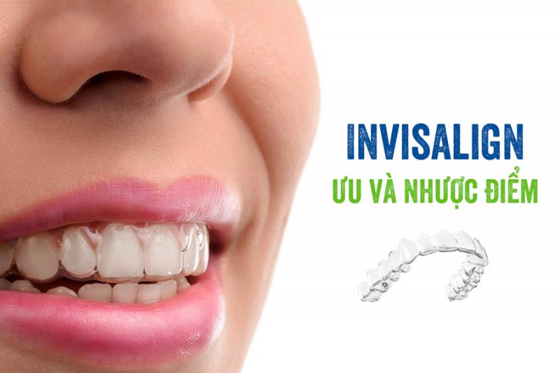 Invisalign là gì và làm thế nào nó khác biệt so với niềng răng truyền thống?
