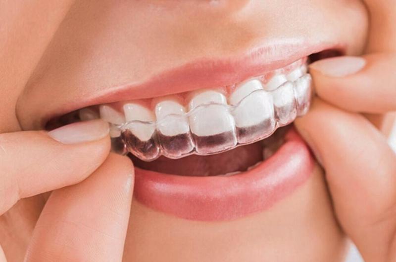 Quá trình làm niềng răng trong suốt Invisalign kéo dài bao lâu?