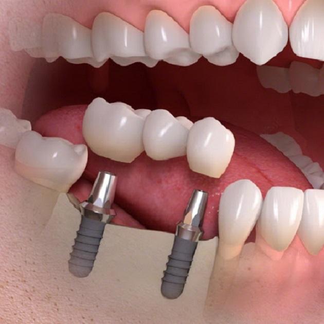 Cầu răng trên implant