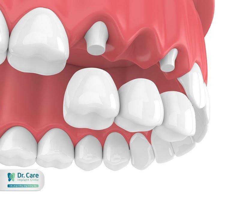Cầu răng trên implant