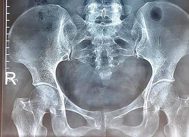 Chụp X-quang bàng quang - niệu đạo