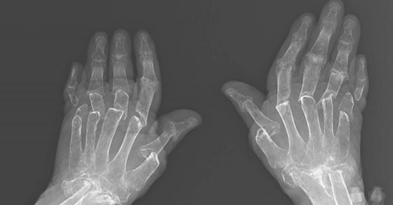 Chụp X-quang để theo dõi sự tiến triển của viêm khớp dạng thấp