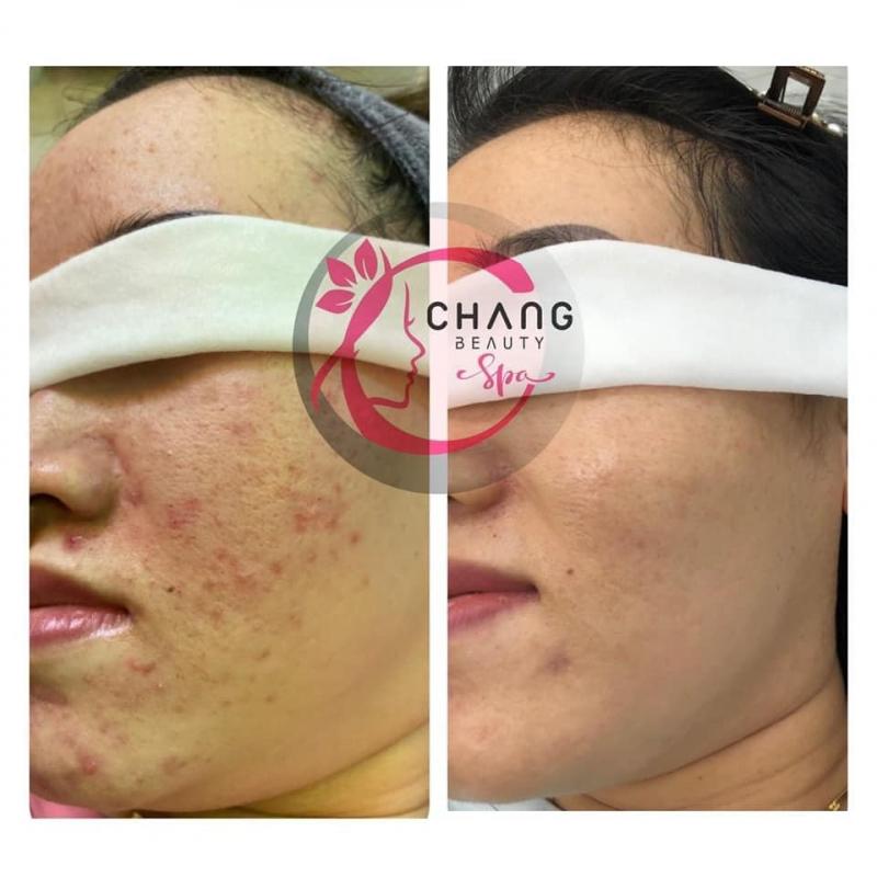 Chang Beauty & Clinic sử dụng từng liệu trình điều trị mụn riêng biệt cho từng làn da, tùy theo mức độ mà có các bước ﻿kết hợp điều trị khác nhau
