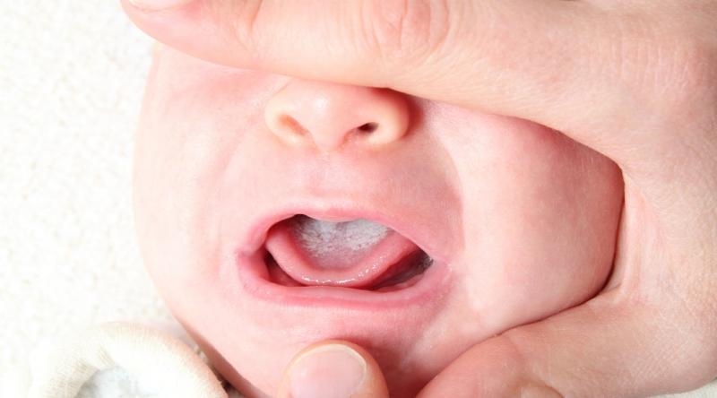 Trẻ dễ bị tưa lưỡi do ngậm vú trong lúc ngủ