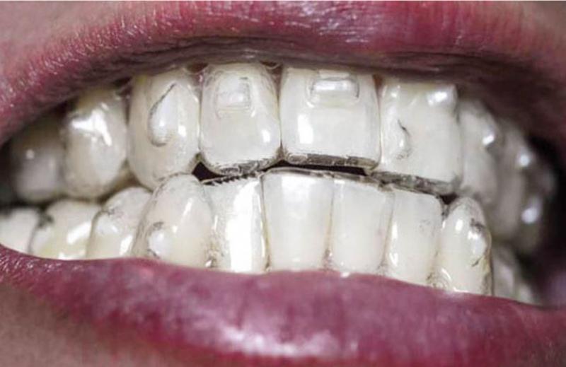 Có những hạn chế gì khi sử dụng Invisalign so với niềng răng truyền thống?