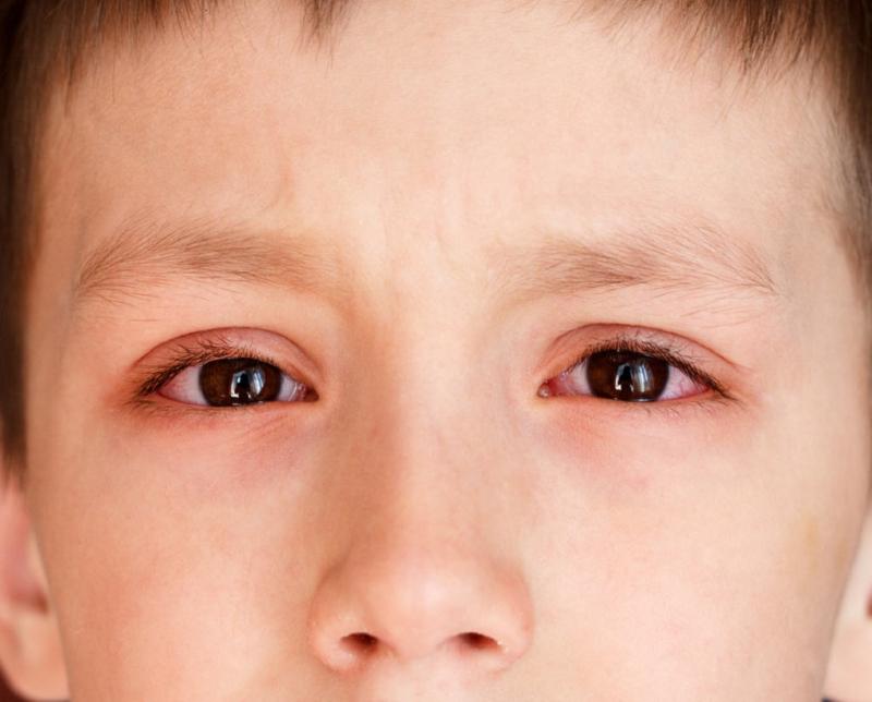 Đau mắt đỏ ở trẻ