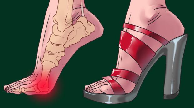 Một trong những tác hại của giày cao gót có thể kể đến là căn bệnh về khớp