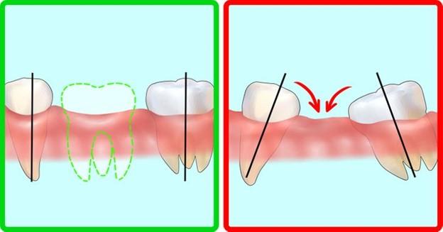 Điều gì sẽ xảy ra nếu bạn mất một chiếc răng trong thời gian dài ?