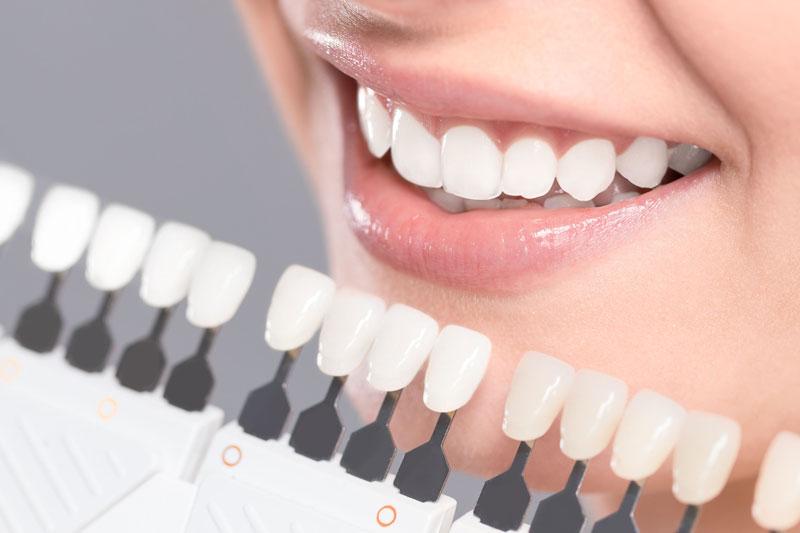 Điều gì xảy ra trong quá trình tẩy trắng răng?