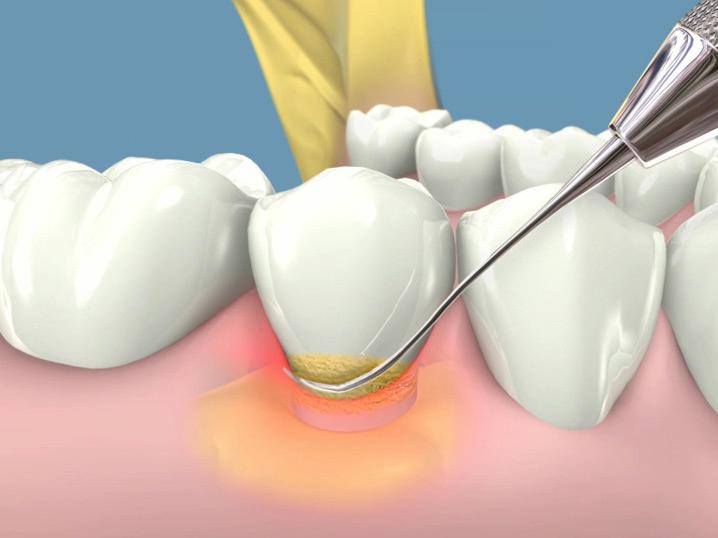 Lấy cao răng giúp điều trị sưng nướu răng