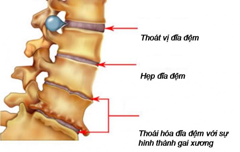 Virut của thoát vị đĩa đệm ảnh hưởng đến xương khớp