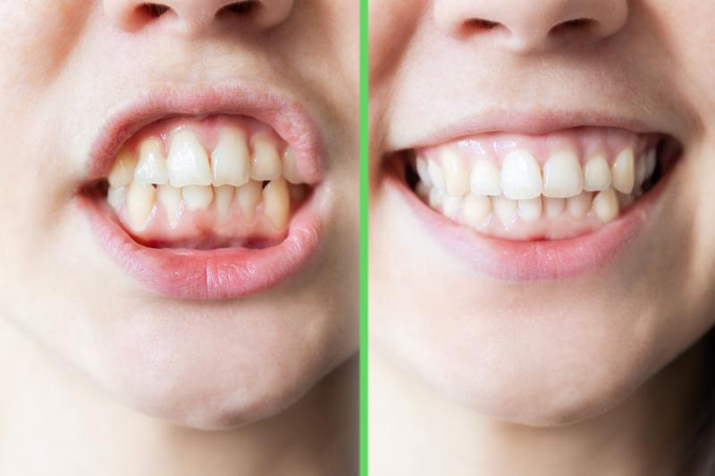 Invisalign có thể được sử dụng để điều trị các vấn đề niềng răng phức tạp không?