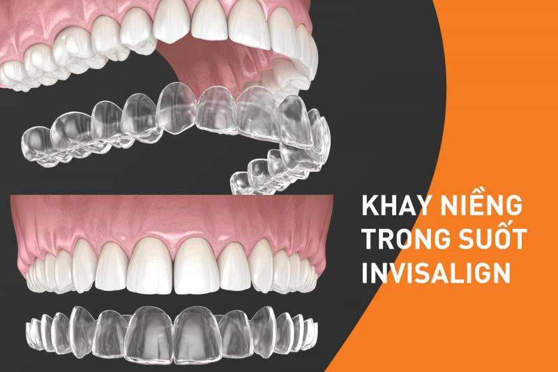 Invisalign có thể giúp giảm đau và không thoải mái như niềng răng truyền thống hay không?