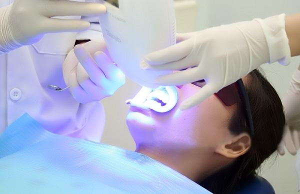 Kỹ thuật tẩy trắng răng bằng laser có hiệu quả không?
