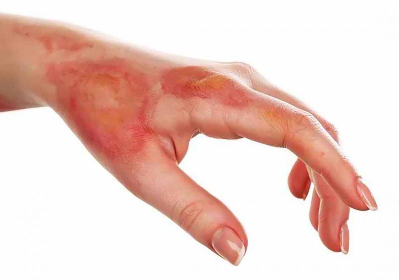 Tinh bột nghệ có tác dụng làm dịu vết bỏng trên da
