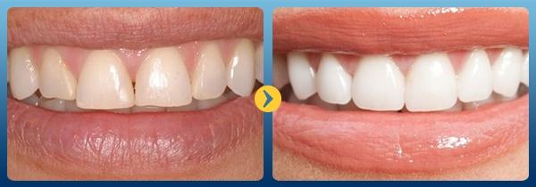 Trước và sau khi làm trắng răng với baking soda