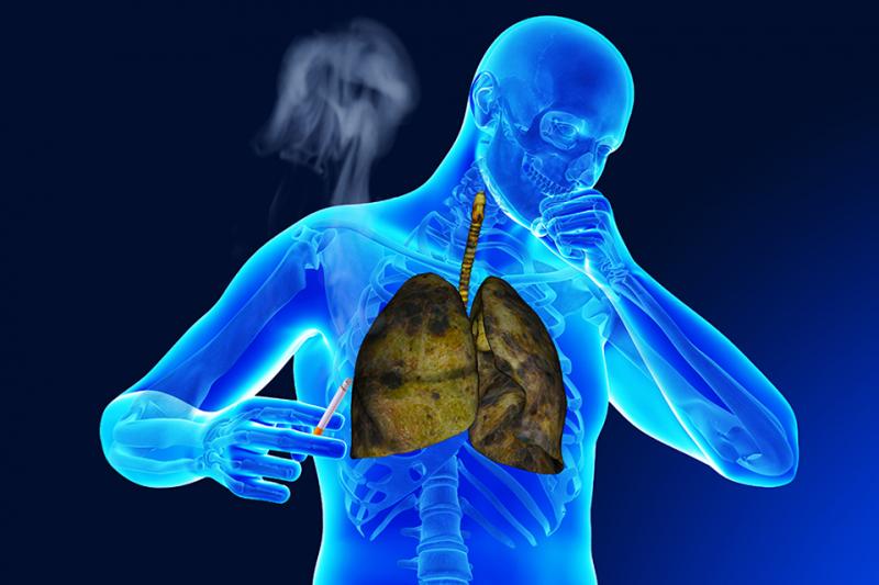 Bệnh lao phổi là bệnh gì?