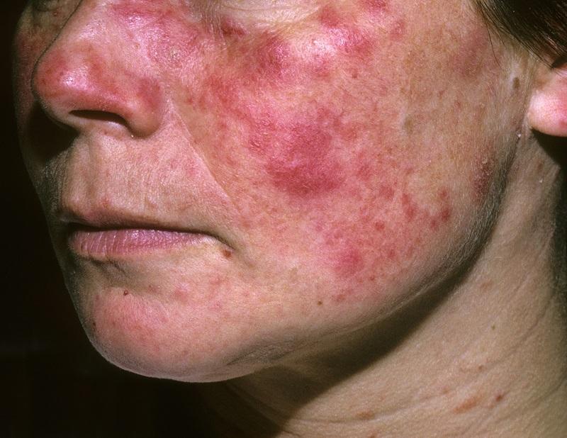 Lupus ban đỏ là bệnh gì?