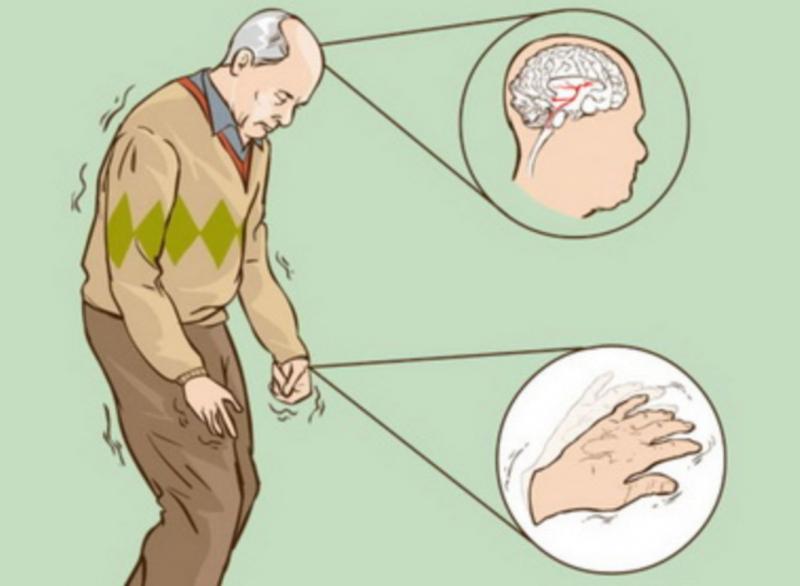 Sản phẩm chỉ định cho bệnh nhân mắc Parkinson