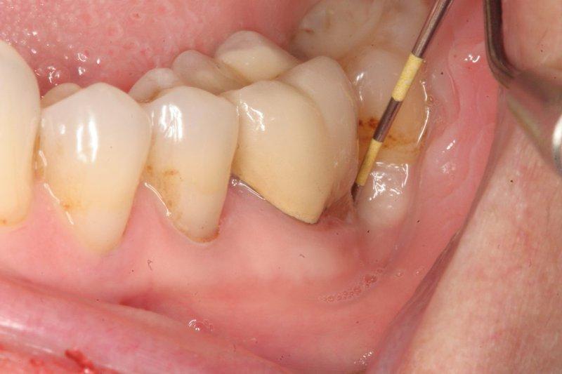 Mô răng bị ảnh hưởng