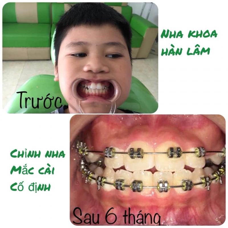 Hình ảnh khách hàng trước và sau điều trị tại Nha khoa Hàn Lâm Thái Nguyên