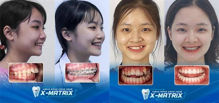 Hình ảnh khách hàng trước và sau niềng răng tại nha khoa Lạc Việt Intech